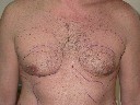 Gynaecomastia male before