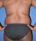 before liposuction waist