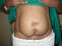 Tummy Tuck Before surgery