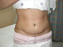 After Tummy Tuck surgery